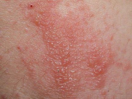 Dermatita atopica (neurodermatita difuza) simptome si semne la adulti