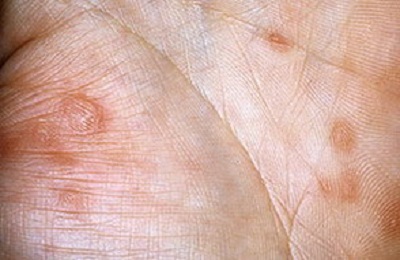 Dermatita atopica (neurodermatita difuza) simptome si semne la adulti