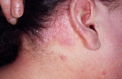 Dermatita atopica (neurodermatita difuza) simptome si semne la adulti