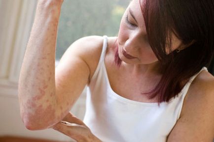 Az atópiás dermatitis felnőttek kezelése, okai, tünetei