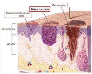 Базаліома - які симптоми цього різновиду раку шкіри і які варіанти лікування існують