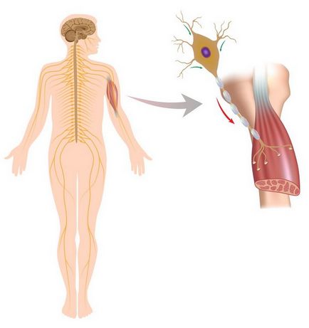 Scleroza laterală amiotrofică, boala lui Sharco, simptomele și cauzele sindromului