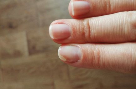 Хвороби нігтів онихолизис або просто гель лак, septemberfrau