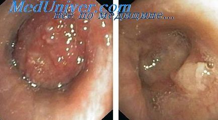 Bronhoscopia în diagnosticul tuberculozei