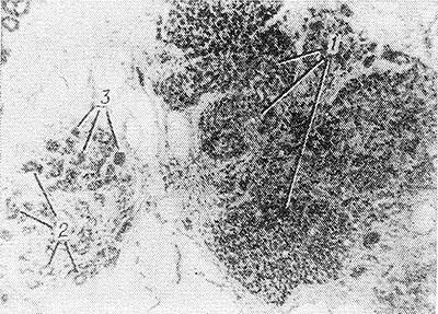 Carcinoma in situ