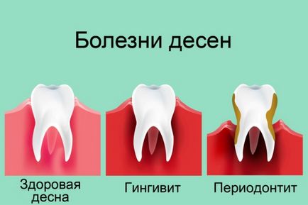 Cum și cum să tratați boala gingiilor