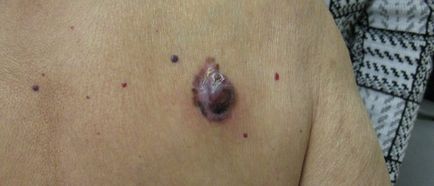 Apoi melanomul diferă de un negru, keratom, semn de naștere