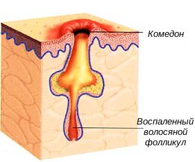 Чорні точки у дитини на обличчі, голові, під пахвами