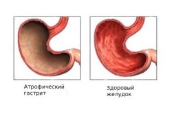 Що робити якщо болить шлунок