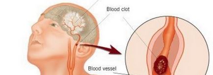 Ce este un accident vascular cerebral - semnele și cauzele sale