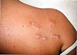 Care este cicatricea coloidală a simptomelor bolii și a tratamentului acesteia