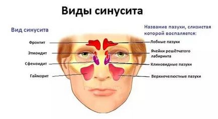 Ce este sinuzita - o clasificare a metodelor sinusite de diagnostic și tratament