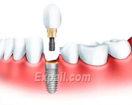 Implantarea dentară a dinților este ieftină