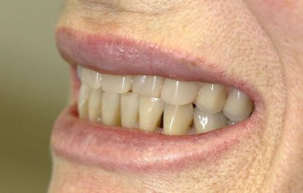 Implantarea dentară a dinților în clinica Moscova, metoda de implantare a suporturilor artificiale, costul și