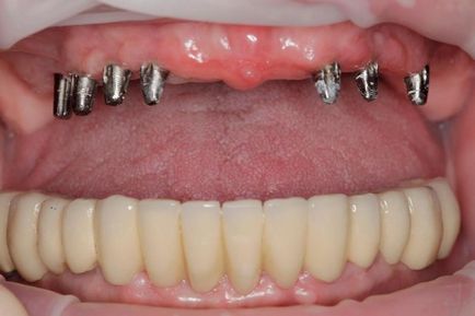 Дентальная імплантація зубів в клініці Москви, метод імплантації штучних опор, вартість і
