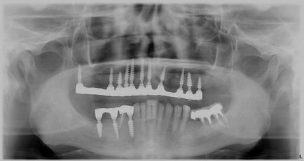 Implantarea dentară a dinților în clinica Moscova, metoda de implantare a suporturilor artificiale, costul și