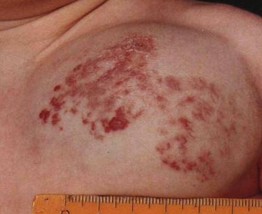 Neoplasmele benigne de pe piele a semnelor de nașteri, nevi, papilomi, limfangiomi, lipomi, fibromas
