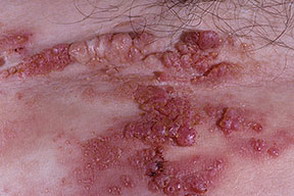 Neoplasmele benigne de pe piele a semnelor de naștere, nevi, papilomi, limfangiomi, lipomi, fibromas