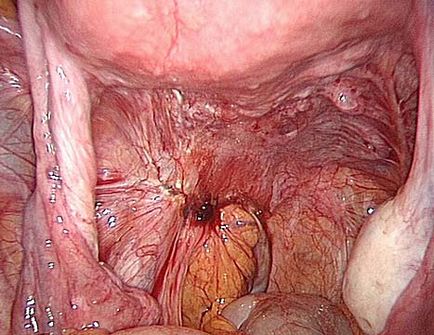 Endometriózis fotó betegségek