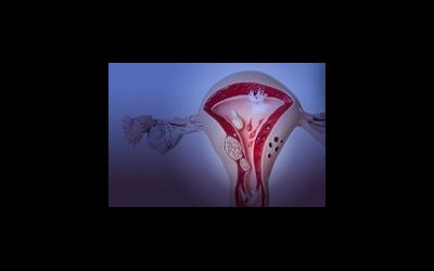 Problemele endometriozelor și perspectivele, care sunt formele endometriozei