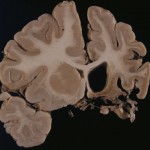 Rasmussen encephalitis