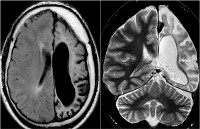 Encefalita din Rasmussen - cauze, simptome, diagnostic și tratament