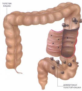 Dacă intestinele sângerau, sfaturile și rețetele