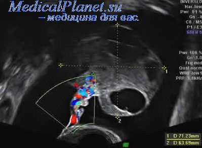 Echografia la răsucirea apendicelor uterului