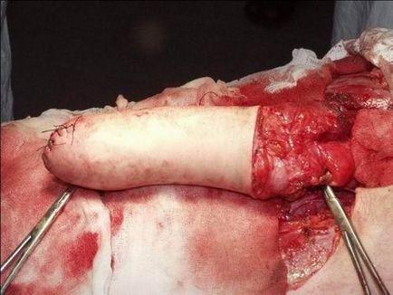 Phalloplasty előtt és után (a thoracodorsal FLAP) Phalloplasty előtt és után