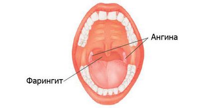 Faringita în timpul sarcinii, cum să tratezi, efectul asupra fătului, ostentiile, decât posibil, cronic