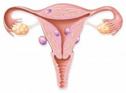 Fibromiomul uterului