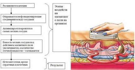 Fizioterápiás sérv ágyéki gerinc - típusú eljárások
