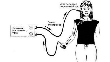 Fizioterápiás sérv ágyéki gerinc - típusú eljárások