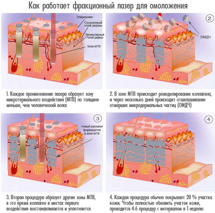 Opinii fracționate cu privire la laserul cu privire la întinerirea fracționată a laserului și la prețurile de procedură