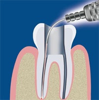 În cazul în care este utilizată stomatologia laser fără durere