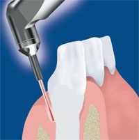 În cazul în care este utilizată stomatologia laser fără durere