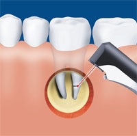 În cazul în care este utilizată stomatologia laser fără durere