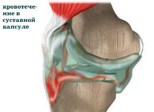 Гемартроз - що це фото, лікування, симптоми