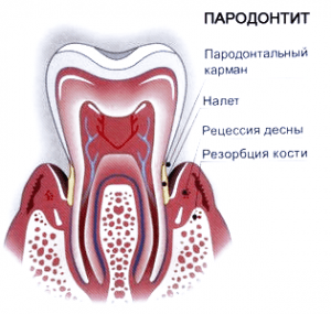 Гінгівіт - симптоми, фото, лікування гінгівіту в домашніх умовах