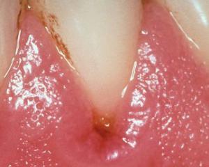 Gingivita simptome și tratament, fotografii de gingivită