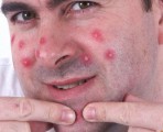 Gennyes pattanások az arcon, mint egy gyulladás csökkentésére, gyógyszerek, mint húzza a genny
