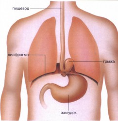 Hernioză a esofagului, simptome, dietă, tratament cu medicamente populare