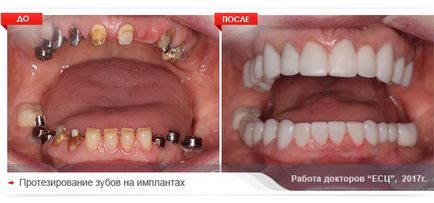 A fogászati ​​implantátumok Jekatyerinburgban, az ár implantátumok (implantátumok) fogak, az Európai