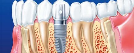 Implantarea dinților în prețurile samariei pentru implantarea dentară a dinților, costul instalării implantului