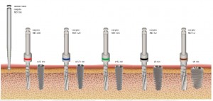 Mirell implantátumok, azok előnyeit és jellemzői