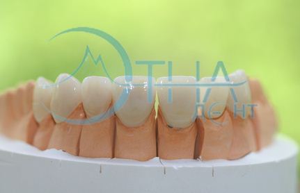 Care sunt tipurile de proteze dentare de pe piață