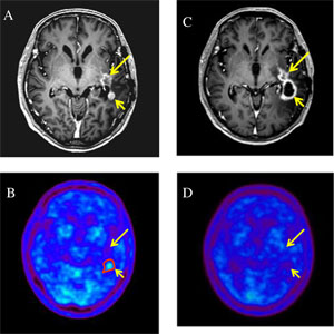 Cum și de ce diagnosticarea PET CT cu metionină