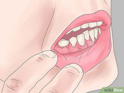 Як позбутися від зубного карієсу природним способом