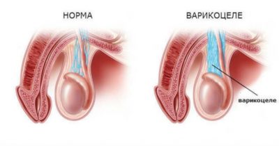 Як лікувати варикоз на ногах у чоловіків чим небезпечний, симптоми і причини