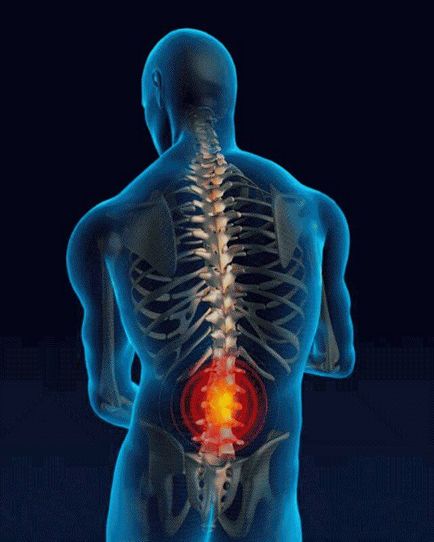 Cum să vindeci o coloană vertebrală lombară fără intervenție chirurgicală
